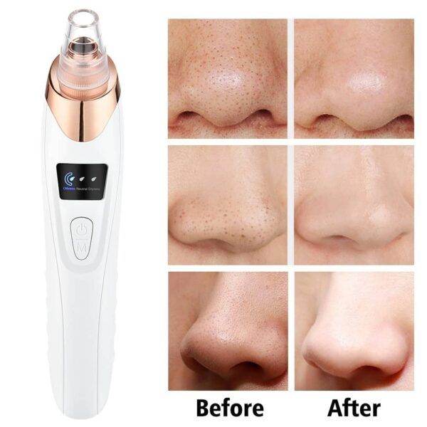 Electric Pore Cleaner & Blackhead Remover – Face Vacuum Suction Tool - YNT Store 